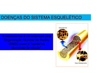 A osteoporose é considerada pela
Organização Mundial de Saúde
(OMS) como a “epidemia
silenciosa do século”.
DOENÇAS DO SISTEMA ESQUELÉTICO
 