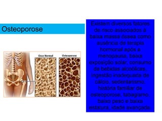 Existem diversos fatores
de risco associados à
baixa massa óssea como
ausência de terapia
hormonal após a
menopausa, baixa
exposição solar, consumo
de bebidas alcoólicas,
ingestão inadequada de
cálcio, sedentarismo,
história familiar de
osteoporose, tabagismo,
baixo peso e baixa
estatura, idade avançada.
Osteoporose
 