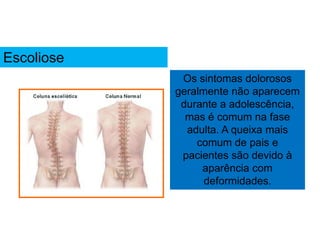 Os sintomas dolorosos
geralmente não aparecem
durante a adolescência,
mas é comum na fase
adulta. A queixa mais
comum de pais e
pacientes são devido à
aparência com
deformidades.
Escoliose
 
