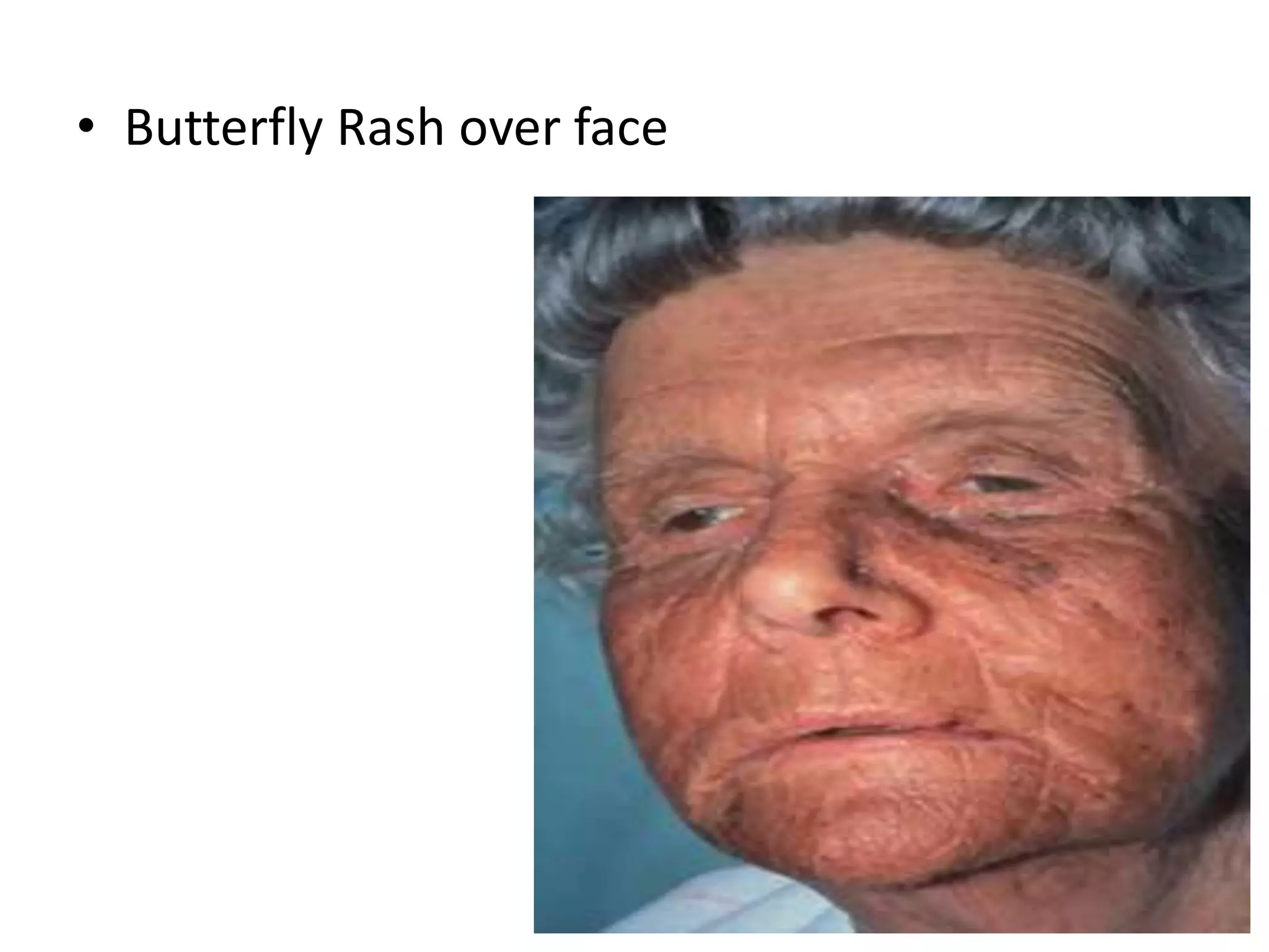 • Butterfly Rash over face

 