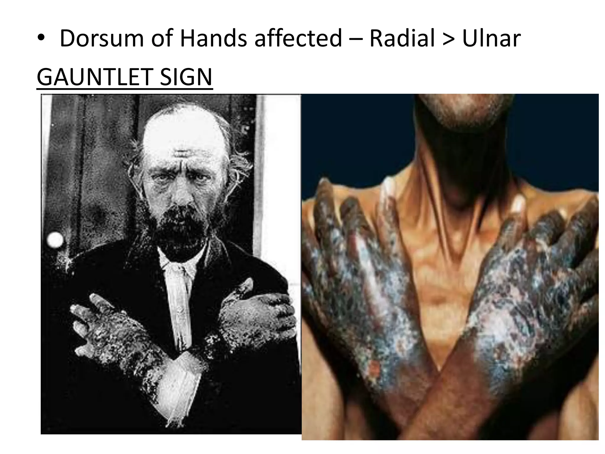• Dorsum of Hands affected – Radial > Ulnar
GAUNTLET SIGN

 