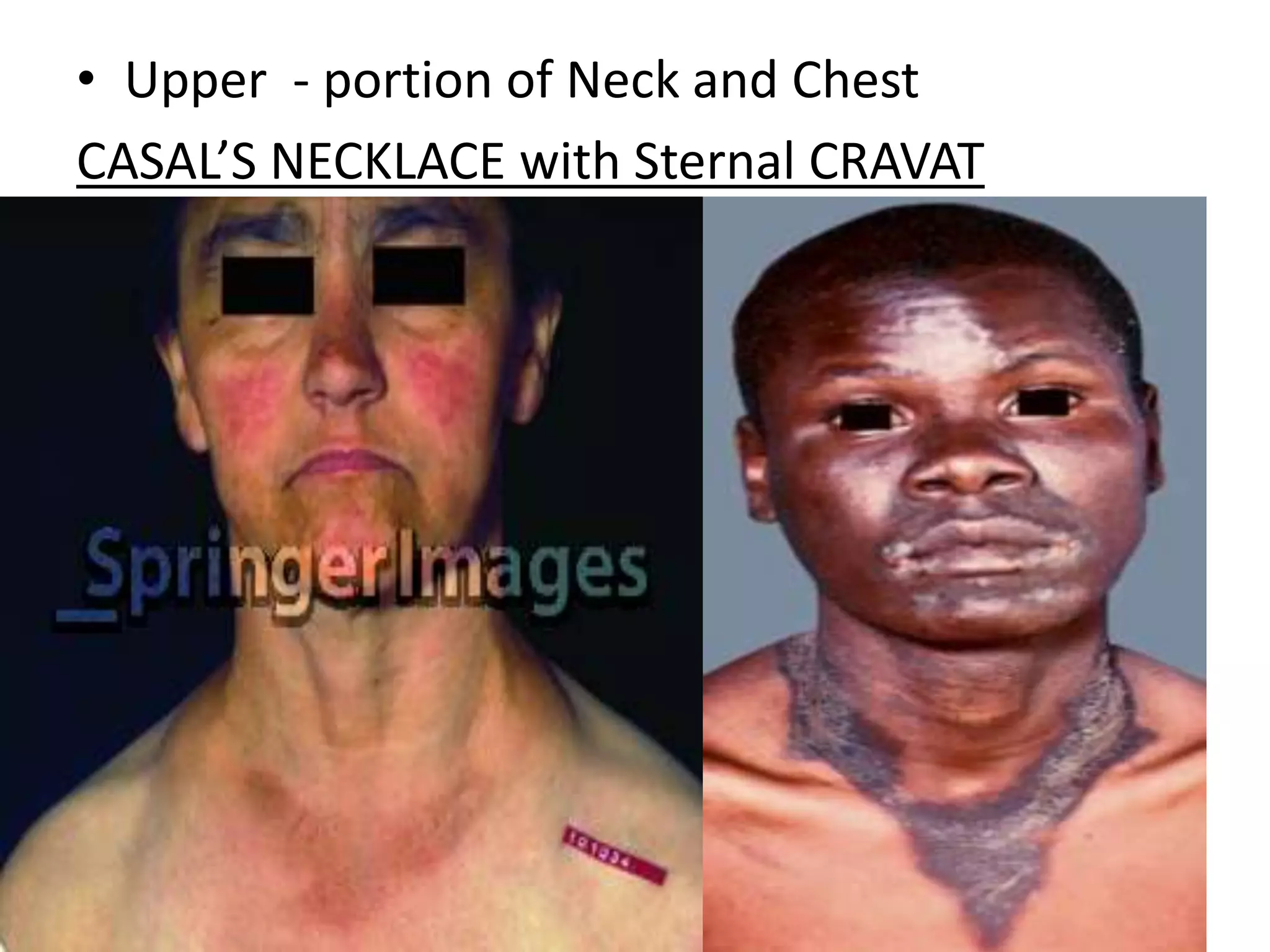 • Upper - portion of Neck and Chest
CASAL’S NECKLACE with Sternal CRAVAT

 