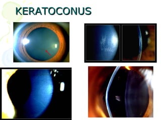 KERATOCONUSKERATOCONUS
 