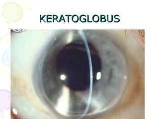 KERATOGLOBUSKERATOGLOBUS
 