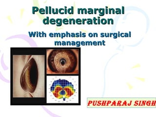 Pellucid marginalPellucid marginal
degenerationdegeneration
With emphasis on surgicalWith emphasis on surgical
managementmanagement
PushParaj singh
 