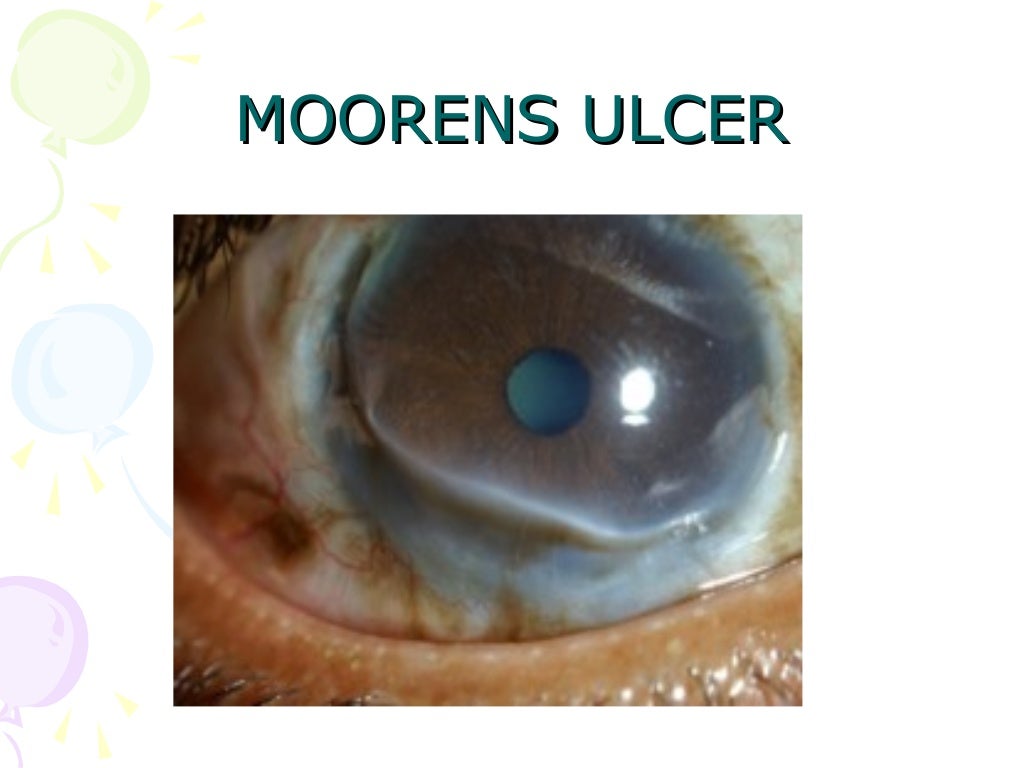 lynden pellucid marginal degeneration