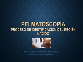 PELMATOSCOPÍA
PROCESO DE IDENTIFICACIÓN DEL RECIÉN
NACIDO
https://www.youtube.com/watch?v=aiToPMbT-x0&feature=emb_logo
https://www.youtube.com/watch?v=hRTECP4tKYY
 