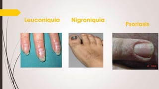 Leuconiquia

Nigroniquia

Psoriasis

 