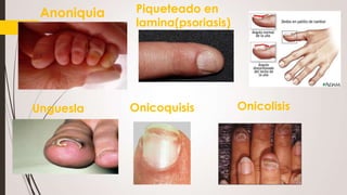 Anoniquia

Unguesla

Piqueteado en
lamina(psoriasis)

Onicoquisis

Onicolisis

 