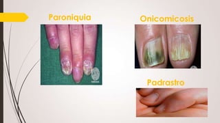 Paroniquia

Onicomicosis

Padrastro

 