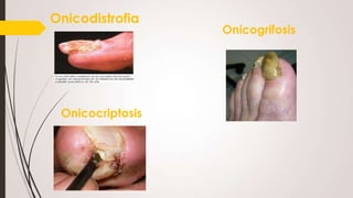 Onicodistrofia

Onicocriptosis

Onicogrifosis

 