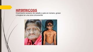 HIPERTRICOSIS
Crecimiento excesivo de cabello o pelo en número, grosor
o longitud en una zona circunscrita

 