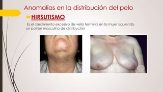 Anomalías en la distribución del pelo
HIRSUTISMO
Es el crecimiento excesivo de vello terminal en la mujer siguiendo
un patrón masculino de distribución

 