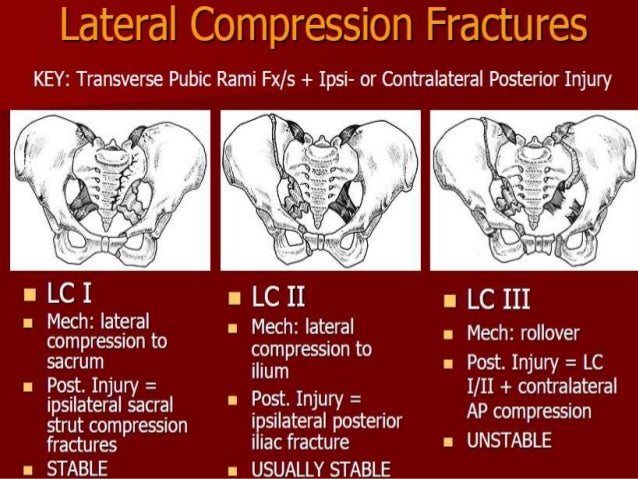 Pelvic and acetabular fractures