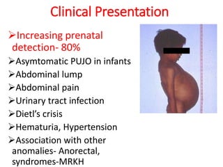 Clinical Presentation
Increasing prenatal
detection- 80%
Asymtomatic PUJO in infants
Abdominal lump
Abdominal pain
Urinary tract infection
Dietl’s crisis
Hematuria, Hypertension
Association with other
anomalies- Anorectal,
syndromes-MRKH
 
