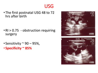 USG
•The first postnatal USG 48 to 72
hrs after birth
•RI > 0.75 - obstruction requiring
surgery
•Sensitivity ~ 90 – 95%,
•Specificity ~ 85%
 