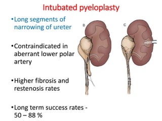 Intubated pyeloplasty
•Long segments of
narrowing of ureter
•Contraindicated in
aberrant lower polar
artery
•Higher fibrosis and
restenosis rates
•Long term success rates -
50 – 88 %
 