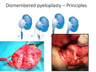 Dismembered pyeloplasty – Principles
 