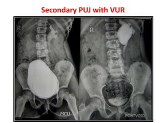 Secondary PUJ with VUR
 