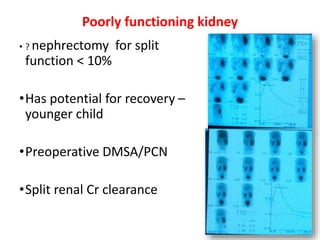 Poorly functioning kidney
• ? nephrectomy for split
function < 10%
•Has potential for recovery –
younger child
•Preoperative DMSA/PCN
•Split renal Cr clearance
 