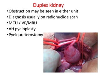 Duplex kidney
•Obstruction may be seen in either unit
•Diagnosis usually on radionuclide scan
•MCU /IVP/MRU
•AH pyeloplasty
•Pyeloureterostomy
 