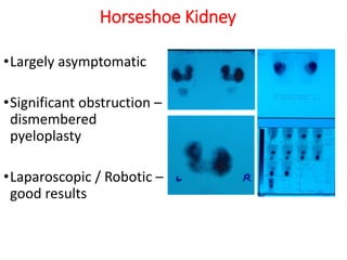 Horseshoe Kidney
•Largely asymptomatic
•Significant obstruction –
dismembered
pyeloplasty
•Laparoscopic / Robotic –
good results
 