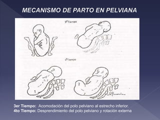 3er Tiempo: Acomodación del polo pelviano al estrecho inferior.
4to Tiempo: Desprendimiento del polo pelviano y rotación externa
 