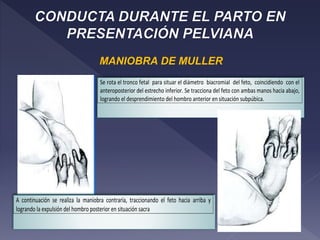MANIOBRA DE MULLER
Se rota el tronco fetal para situar el diámetro biacromial del feto, coincidiendo con el
anteroposterior del estrecho inferior. Se tracciona del feto con ambas manos hacia abajo,
logrando el desprendimiento del hombro anterior en situación subpúbica.
A continuación se realiza la maniobra contraria, traccionando el feto hacia arriba y
logrando la expulsión del hombro posterior en situación sacra
 
