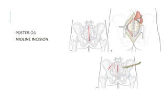 PELVIC FRACTURES – ANATOMY, TYPES, MANAGEMENT &OUTCOME - EVIDENCE BASED ...