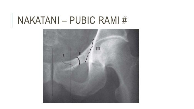 PELVIC FRACTURES - ANATOMY, TYPES, MANAGEMENT &OUTCOME ...