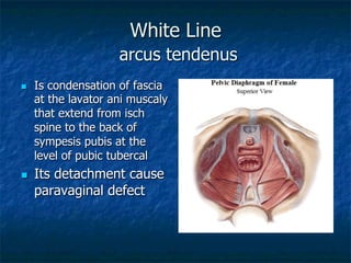 White Line
arcus tendenus
n  Is condensation of fascia
at the lavator ani muscaly
that extend from isch
spine to the back of
sympesis pubis at the
level of pubic tubercal
n  Its detachment cause
paravaginal defect
 