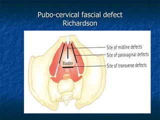 Pubo-cervical fascial defect
Richardson
 