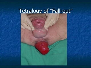Tetralogy of “Fall-out”
 