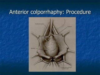 Anterior colporrhaphy: Procedure
 