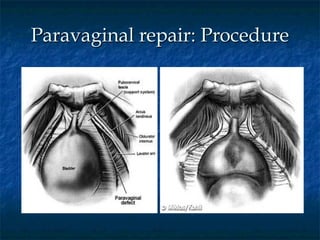 Paravaginal repair: Procedure
 