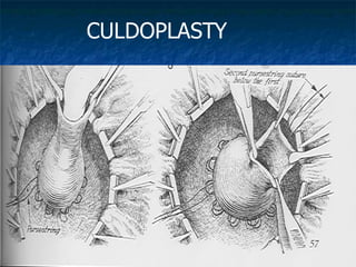 CULDOPLASTY
 