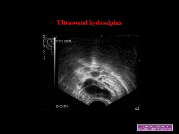31+ Adnexal Tenderness Causes Pics