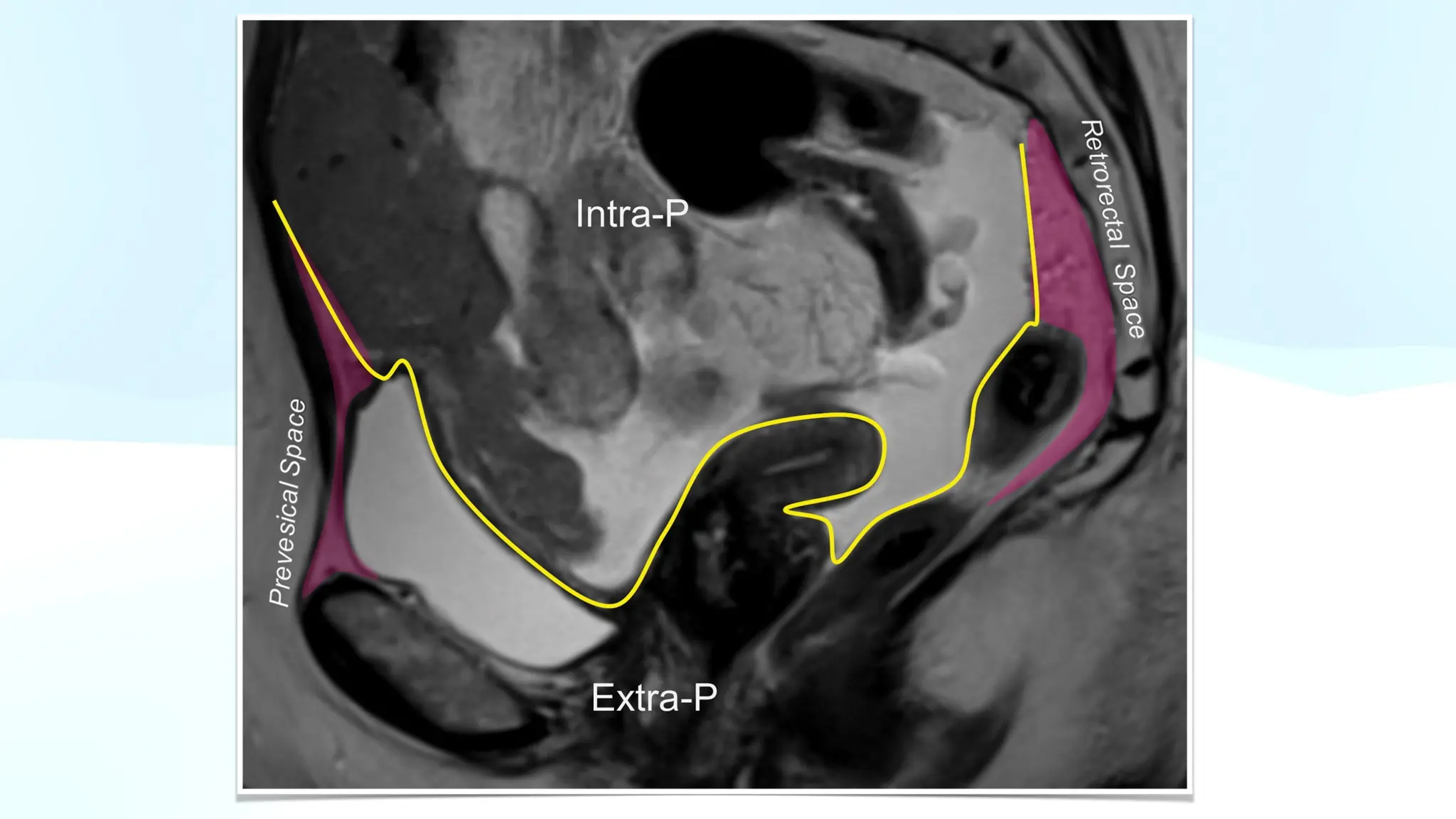 Pelvic Anatomy MRI OF MALE AND FEMALE PELVIS pptx
