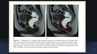 Pelvic Anatomy MRI OF MALE AND FEMALE PELVIS pptx