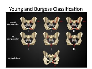 Lundborg's Classification Pelvic and Retroperitoneal Trauma. pptx | PPTX
