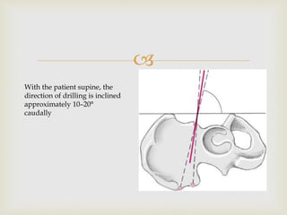 
With the patient supine, the
direction of drilling is inclined
approximately 10–20°
caudally
 