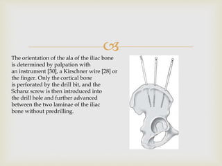 
The orientation of the ala of the iliac bone
is determined by palpation with
an instrument [30], a Kirschner wire [28] or
the finger. Only the cortical bone
is perforated by the drill bit, and the
Schanz screw is then introduced into
the drill hole and further advanced
between the two laminae of the iliac
bone without predrilling.
 