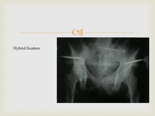 
Hybrid fixation
 
