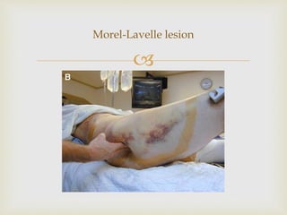 
Morel-Lavelle lesion
 