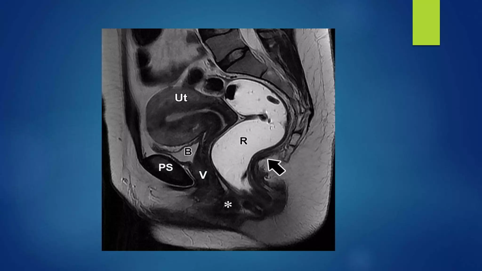MR BASED IMAGING OF FEMALE PELVIC FLOOR | PPTX