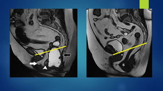 MR BASED IMAGING OF FEMALE PELVIC FLOOR | PPTX