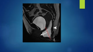 MR BASED IMAGING OF FEMALE PELVIC FLOOR | PPTX