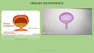 pelvic floor muscle and it's dysfunction 10
URINARY INCONTINENCE
 
