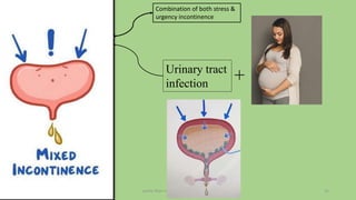pelvic floor muscle and it's dysfunction 15
Combination of both stress &
urgency incontinence
+
Urinary tract
infection
 
