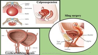 pelvic floor muscle and it's dysfunction
19
Colposuspension
Sling surgery
Urethral bulking agents
 